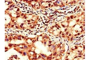 Immunohistochemistry of paraffin-embedded human lung cancer using ABIN7175942 at dilution of 1:100 (YTHDF2 antibody  (AA 201-500))