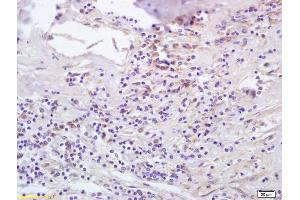 Formalin-fixed and paraffin embedded human lung carcinoma labeled with Anti-CCL5/RANTES Polyclonal Antibody, Unconjugated (ABIN674949) at 1:200 followed by conjugation to the secondary antibody and DAB staining. (CCL5 antibody  (AA 62-91))