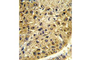 Formalin-fixed and paraffin-embedded human hepatocarcinoma reacted with DCT Antibody (N-term), which was peroxidase-conjugated to the secondary antibody, followed by DAB staining. (DCT antibody  (N-Term))