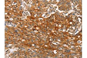 The image on the left is immunohistochemistry of paraffin-embedded Human gastic cancer tissue using ABIN7190272(CLDN11 Antibody) at dilution 1/25, on the right is treated with synthetic peptide. (Claudin 11 antibody)