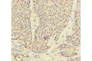 Immunohistochemistry of paraffin-embedded human ovarian cancer using ABIN7175186 at dilution of 1:100 (UACA antibody  (AA 1-90))