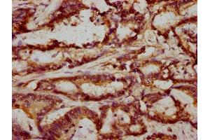 IHC image of ABIN7152685 diluted at 1:293 and staining in paraffin-embedded human colon cancer performed on a Leica BondTM system.