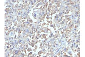 Formalin-fixed, paraffin-embedded human histiocytoma stained with TNF alpha Mouse Monoclonal Antibody (MAb1). (TNF alpha antibody)