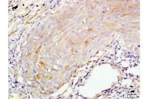 Formalin-fixed and paraffin embedded human lung carcinoma tissue labeled with Anti-S100A7 Polyclonal Antibody, Unconjugated  at 1:200 followed by conjugation to the secondary antibody and DAB staining