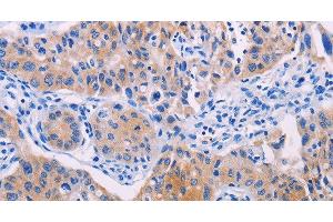 Immunohistochemistry of paraffin-embedded Human lung cancer using AGT Polyclonal Antibody at dilution of 1:30 (AGT antibody)