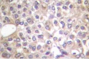 Immunohistochemistry (IHC) analyzes of p-PI3K p85 (pTyr458)/p55 (pTyr199) antibody in paraffin-embedded human breast carcinoma tissue. (PIK3R1 antibody  (pTyr199, pTyr458))