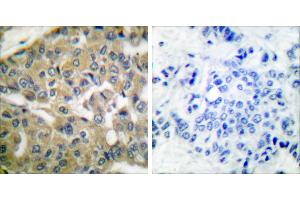 Peptide - +Immunohistochemical analysis of paraffin-embedded human breast carcinoma tissue using FHIT antibody (#C0193). (FHIT antibody)