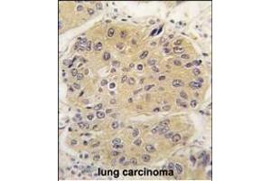 Formalin-fixed and paraffin-embedded human lung carcinoma tissue reacted with EIF4A1 antibody (N-term) (ABIN391393 and ABIN2841397) , which was peroxidase-conjugated to the secondary antibody, followed by DAB staining.