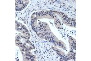 Immunohistochemistry of paraffin-embedded human colon carcinoma using XPD/ERCC2 Rabbit mAb (ABIN7267057) at dilution of 1:100 (40x lens). (ERCC2 antibody)