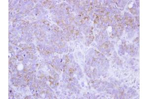 IHC-P Image Immunohistochemical analysis of paraffin-embedded SW480 xenograft, using ST3GAL2, antibody at 1:100 dilution. (ST3GAL2 antibody)