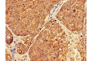 Immunohistochemistry of paraffin-embedded human ovarian cancer using ABIN7162911 at dilution of 1:100 (PER3 antibody  (AA 1-131))