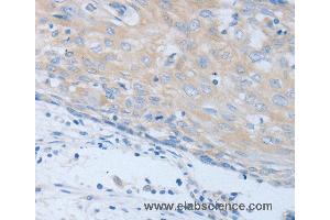Immunohistochemistry of Human cervical cancer using CHRFAM7A Polyclonal Antibody at dilution of 1:40 (CHRNA7 antibody)