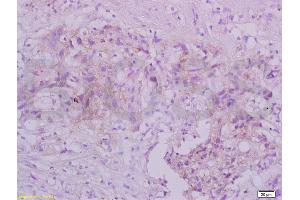 Formalin-fixed and paraffin embedded human gastric carcinoma tissue labeled with Anti-TRAF3/CD40bp Polyclonal Antibody, Unconjugated (ABIN738921) at 1:200 followed by conjugation to the secondary antibody and DAB staining (TRAF3 antibody  (AA 101-200))