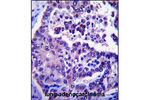 ARL8A Antibody (Center) (ABIN657381 and ABIN2846426) immunohistochemistry analysis in formalin fixed and paraffin embedded human lung adenocarcinoma followed by peroxidase conjugation of the secondary antibody and DAB staining. (ARL8A antibody  (AA 82-110))
