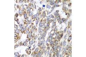 Immunohistochemistry of paraffin-embedded human esophageal cancer using DLST antibody at dilution of 1:100 (x40 lens). (DLST antibody)