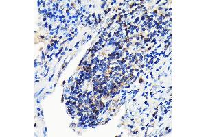Immunohistochemistry of paraffin-embedded human lung cancer using GRB2 Rabbit mAb (ABIN7267518) at dilution of 1:100 (40x lens). (GRB2 antibody)