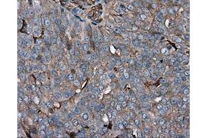 Immunohistochemical staining of paraffin-embedded Adenocarcinoma of colon tissue using anti-RC200180 mouse monoclonal antibody.