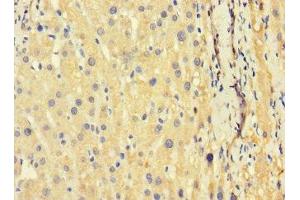 Immunohistochemistry of paraffin-embedded human liver cancer using ABIN7173626 at dilution of 1:100 (TSC22D3 antibody  (AA 58-134))
