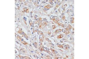 Immunohistochemistry of paraffin-embedded human breast cancer using DLL1 antibody (ABIN7266726) at dilution of 1:100 (40x lens). (DLL1 antibody  (AA 573-723))