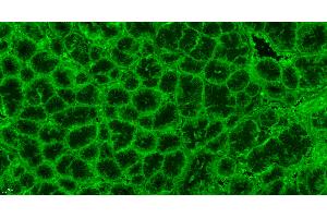 Paraformaldehyde-fixed, paraffin embedded human stomach cancer; Antigen retrieval by boiling in sodium citrate buffer (pH6. (Caspase 9 antibody  (AA 11-120) (FITC))