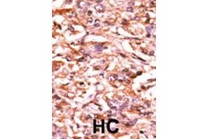 Formalin-fixed and paraffin-embedded human cancer tissue reacted with the primary antibody, which was peroxidase-conjugated to the secondary antibody, followed by AEC staining. (CDC25B antibody  (pSer187))