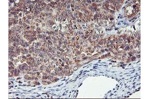 Immunohistochemical staining of paraffin-embedded Adenocarcinoma of Human ovary tissue using anti-AGPAT5 mouse monoclonal antibody. (AGPAT5 antibody)