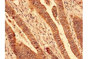 Immunohistochemistry analysis of human colon cancer using ABIN7163605 at dilution of 1:100 (PAFAH1B2 antibody  (AA 2-229))