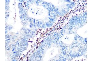 Immunohistochemistry of paraffin-embedded human colon carcinoma using Galectin 1/LG Rabbit mAb (ABIN7268197) at dilution of 1:100 (40x lens). (LGALS1/Galectin 1 antibody)