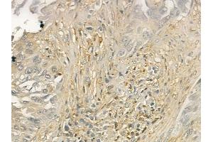 ABIN6260596 and ABIN6277004 at 1/100 staining human lung squamous cell carcinoma by IHC-P.