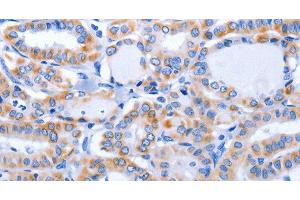 Immunohistochemistry of paraffin-embedded Human thyroid cancer using GFER Polyclonal Antibody at dilution of 1:50 (GFER antibody)