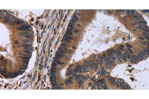 Immunohistochemistry of paraffin-embedded Human colon cancer tissue using FSTL1 Polyclonal Antibody at dilution 1:30 (FSTL1 antibody)