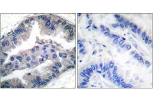 Immunohistochemical staining of paraffin-embedded human lung carcinoma tissue reacted with BIK (phospho T33) polyclonal antibody  at 1:50-1:100 dilution. (BIK antibody  (pThr33))