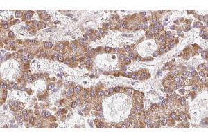 ABIN6273974 at 1/100 staining Human liver cancer tissue by IHC-P. (OR1L4/1L6 antibody)