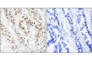 Immunohistochemistry analysis of paraffin-embedded human breast carcinoma, using BRCA1 (Phospho-Ser1524) Antibody. (BRCA1 antibody  (pSer1524))