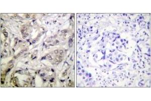 Immunohistochemistry analysis of paraffin-embedded human breast carcinoma tissue, using CaMK1-alpha (Ab-177) Antibody. (CAMK1 antibody  (AA 143-192))
