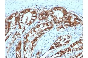 Immunohistochemistry (IHC) image for anti-Epithelial Cell Adhesion Molecule (EPCAM) (AA 77-202), (Extracellular Domain) antibody (ABIN6939978)