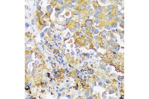 Immunohistochemistry of paraffin-embedded human lung cancer using ZDHHC18 antibody (ABIN7271549) at dilution of 1:100 (40x lens). (ZDHHC18 antibody  (AA 301-388))