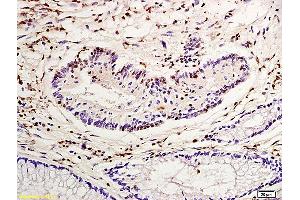 Formalin-fixed and paraffin embedded human colon carcinoma labeled with Anti-Nucleophosmin Polyclonal Antibody, Unconjugated (ABIN1387533) at 1:200 followed by conjugation to the secondary antibody and DAB staining (NPM1 antibody  (AA 21-120))