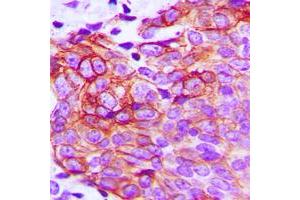 Immunohistochemical analysis of Claudin 1 staining in human breast cancer formalin fixed paraffin embedded tissue section. (Claudin 1 antibody  (C-Term))