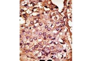 Formalin-fixed and paraffin-embedded human cancer tissue reacted with the primary antibody, which was peroxidase-conjugated to the secondary antibody, followed by AEC staining. (CCBP2 antibody  (N-Term))