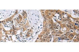 Immunohistochemistry of paraffin-embedded Human esophagus cancer tissue using THOC3 Polyclonal Antibody at dilution of 1:85(x200)