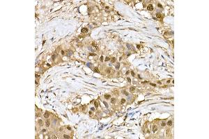 Immunohistochemistry of paraffin-embedded human breast cancer using ERK1/2 Rabbit mAb (ABIN7268620) at dilution of 1:100 (40x lens). (ERK1 antibody)