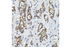Immunohistochemistry of paraffin-embedded human colon carcinoma using SURF1 antibody (ABIN2560237) at dilution of 1:100 (40x lens). (SURF1 antibody)