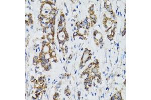 Immunohistochemistry of paraffin-embedded human colon carcinoma using SURF1 antibody (ABIN2560237) at dilution of 1:100 (40x lens).