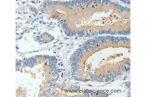 Immunohistochemistry of Human colon cancer using BAAT Polyclonal Antibody at dilution of 1:30 (BAAT antibody)