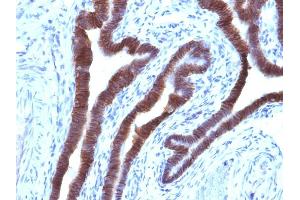 Formalin-fixed, paraffin-embedded human Ovarian Carcinoma stained with EpCAM Mouse Monoclonal Antibody (EGP40/1110). (EpCAM antibody  (Cytoplasmic Domain))