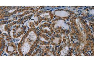 Immunohistochemistry of paraffin-embedded Human thyroid cancer using NDUFA5 Polyclonal Antibody at dilution of 1:60