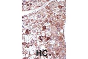 Formalin-fixed and paraffin-embedded human cancer tissue reacted with the primary antibody, which was peroxidase-conjugated to the secondary antibody, followed by DAB staining. (PCK1 antibody  (N-Term))