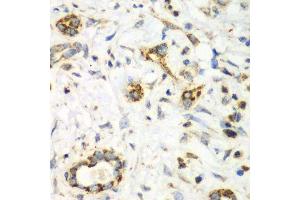 Immunohistochemistry of paraffin-embedded human liver cancer using NRBF2 antibody.
