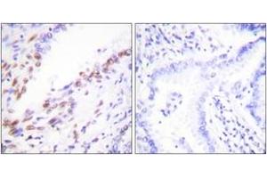 Immunohistochemistry analysis of paraffin-embedded human lung carcinoma tissue, using Ki67 Antibody. (Ki-67 antibody  (AA 3207-3256))